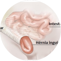 ULTRASONIDO INGUINAL